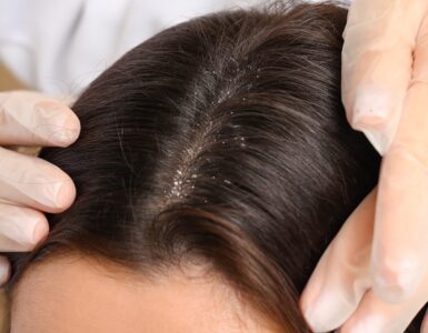 Dandruff scale analysis with doctor