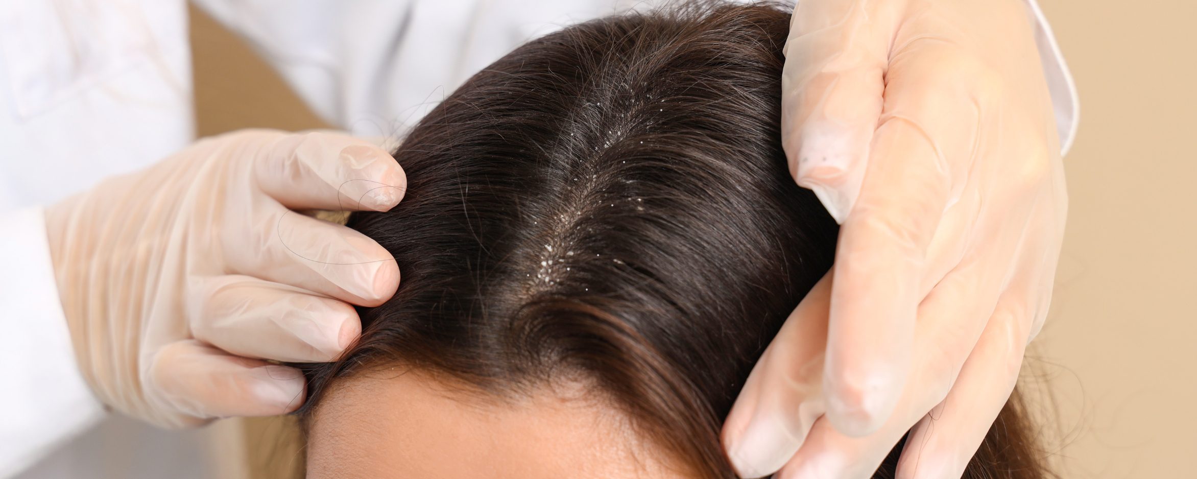 Dandruff scale analysis with doctor